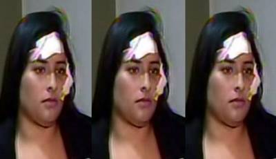 Joven quedó desfigurada tras ser agredida por venezolana en San Juan de Lurigancho 