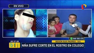 SJL: niña sufrió corte en el rostro y recibió 32 puntos de sutura